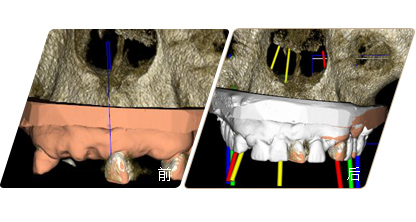 數(shù)字化種植牙設(shè)計(jì)軟件前后對(duì)比