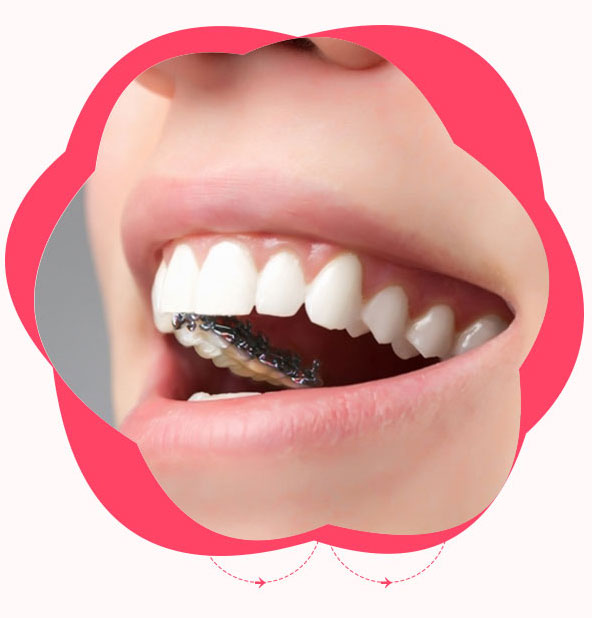 數(shù)碼舌側(cè)隱形正畸